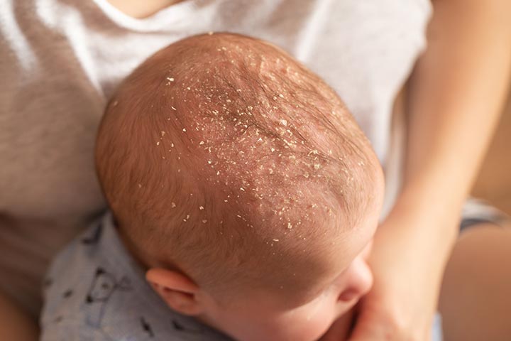 أسباب جفاف فروة الرأس وظهور قشرة الشعر عند الأطفال