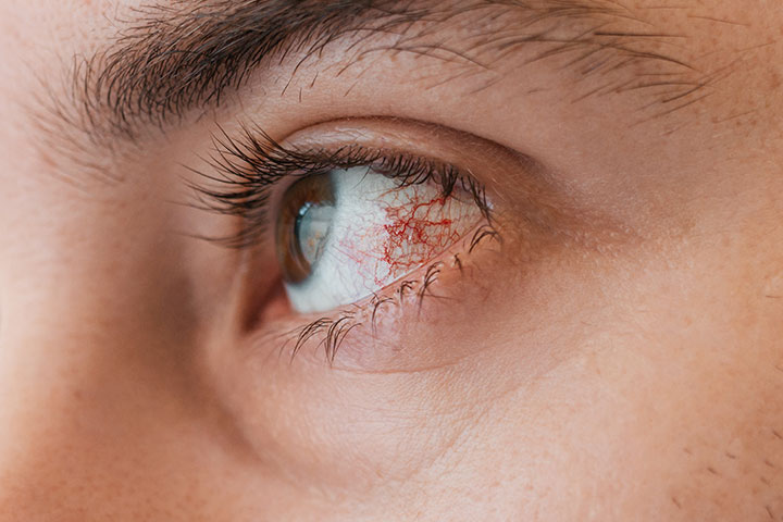 كيف يمكن أن يتسبب مكياج عينيك بإصابتك بعدوى أو العمى؟