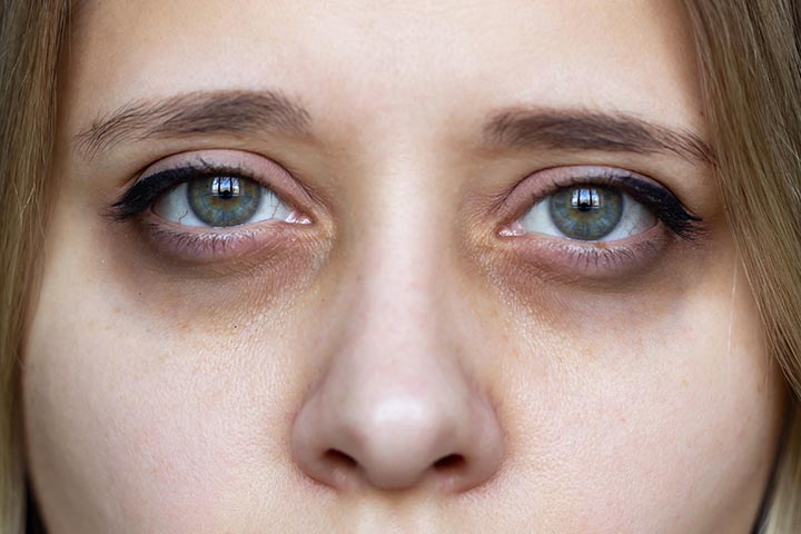 10 علاجات منزلية للهالات السوداء تحت عينيكِ