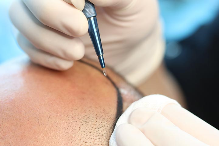 معلومات تهمك عن عمليات زراعة الشعر في مصر